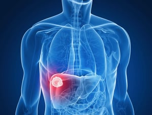 Liver Cancer